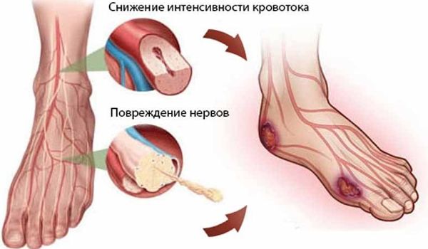 Почему отказывают ноги от алкоголя?