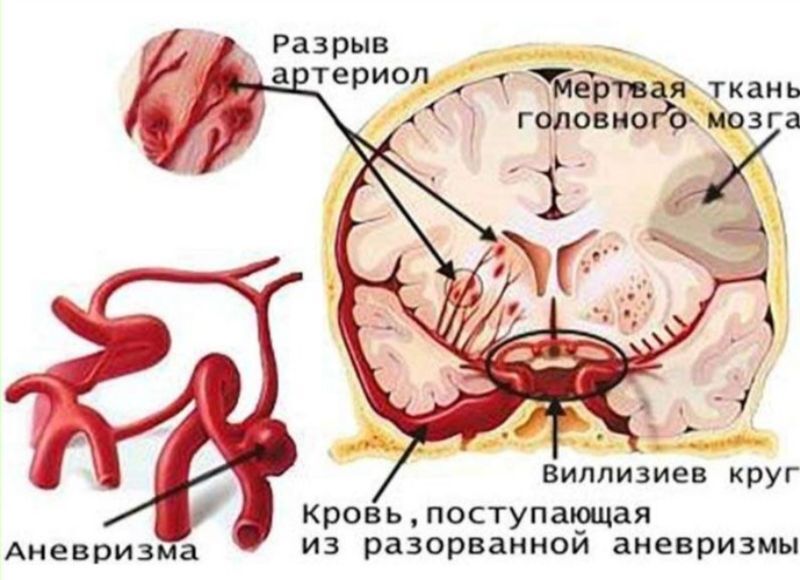 Алкоголь и мозг. Какие изменения происходят при регулярном употреблении?
